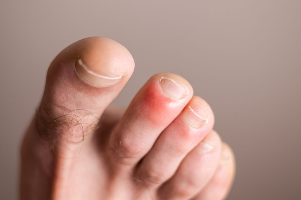 Chilblains
